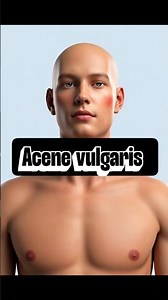 Acne Vulgaris Explained by animation | Adult Health Nursing #shorts