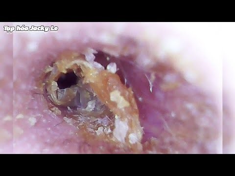 Ear Wax Removal #119: Earwax And Dead Skin Make Him Itch Unbearably | Ear Cleaning ASMR
