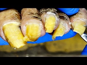 The Complete Trimming Process Of Onychomycosis, Each Nail Is Restored To Health【Podiatry Clinic】