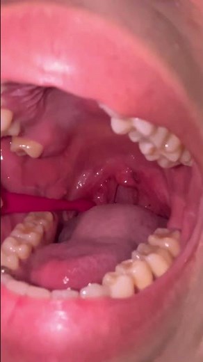 Remoção de caseum #asmr #satisfying #tonsilstones #removal
