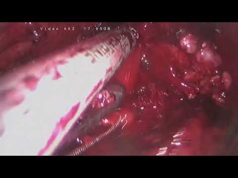 laparoscopic radical prostatectomy after TURP