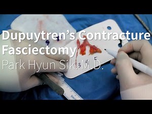 Dupuytren's Contracture Fasciectomy