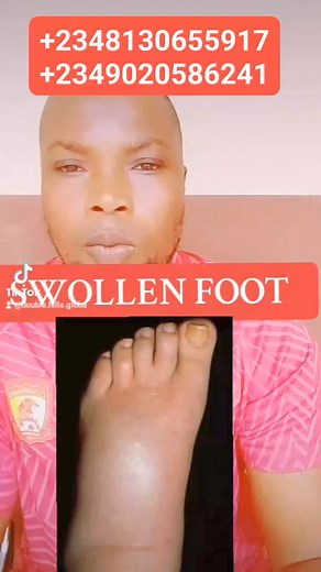 SWOLLEN FOOT | Double Hills Global Herbs TV.