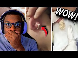 Biggest EAR Cyst Pop Ever Caught on Camera