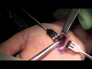 Open Carpal Tunnel Release • Video • MEDtube.net