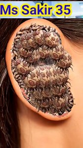 Women Ear Treatment ASMR | 2D Maggot Removal Animation #asmrvideo #asmrsounds #reelsvideoシ | Ms Sakir 35