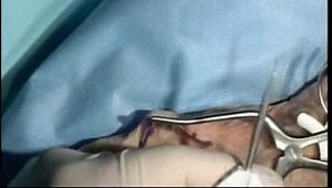 Ulnar Collateral Ligament Repair