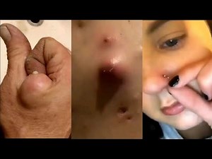 How to pop a giant boil on back, pimple & cyst popping this week, blackheads, zits and acne treatmen