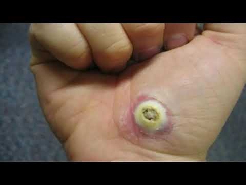 PLANTAR WART REMOVAL DUCT TAPE: This Method Is The Only One That Has Worked For Me.
