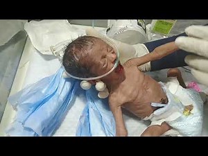 Critical Emergency Care of a Very Weak Newborn Baby on Oxygen in the NICU | Life-Saving Support