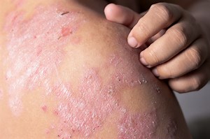 Eczema: causes and symptoms | Emergency Live