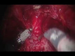 Prostatectomy da Vinci® Si™ HD Clip #4