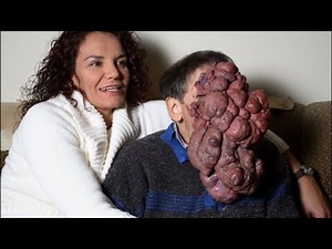 10 People with Extreme Deformities