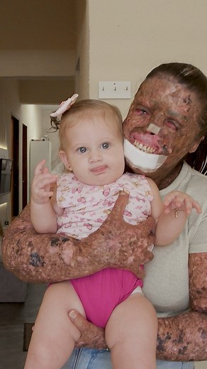 I'm Allergic To Sunlight - But My Baby Is Healthy ❤️ #reels #parenting #babies | Shake My Beauty