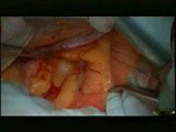 Open Right Hemicolectomy – Technical Principles - Operation No 1 - Part 1 • Video • MEDtube.net