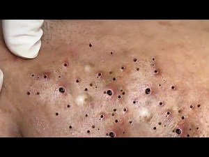 Treatment of Perennial Blackheads at Sac Dep Spa