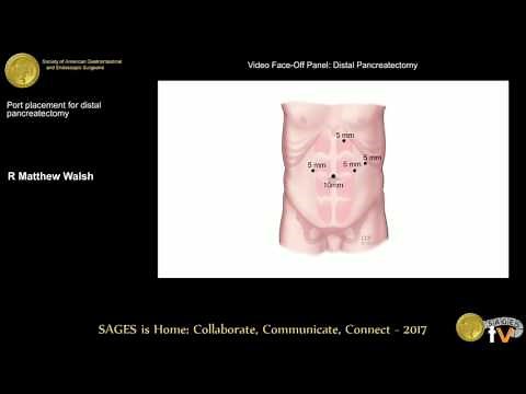 Port placement for distal pancreatectomy