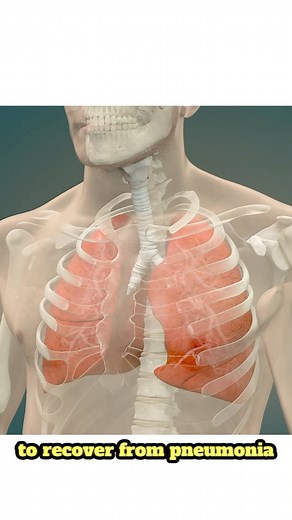 How long does it take to recover from pneumonia? #pneumonia #lungs #recovery #breathing | iMaster Health Inc