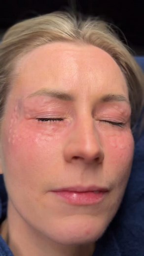 Friskere blikk på få minutter? 🤩 Jalupro Young Eyes er en innovativ injeksjonsbehandling spesielt utviklet for det sensitive området under øynene – og gir synlig forbedring av fine linjer, mørke ringer og tretthetstegn.🫩 Resultat? Et våkent, hydrert og ungdommelig uttrykk – helt uten en “overbehandlet” look. Denne behandlingen passer for deg som ønsker et naturlig løft. Aldersgrense 23 år Begrensede timer før sommeren – sikre din plass i dag. Send oss en DM eller book direkte via linken i bio.