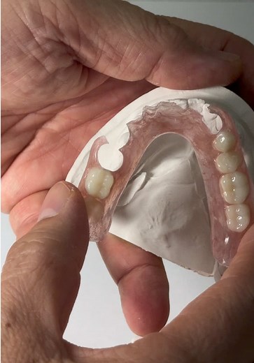 FiberFlex Partial Denture for Dr. Lisa Hofstad in Florida