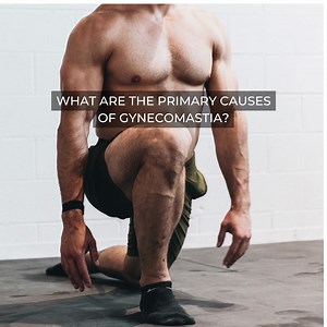 One of the most commonly known causes of gynecomastia is imbalances in hormone levels – this is where testosterone and oestrogen come into play. Gynecomastia develops when the testosterone level is much lower in relation to oestrogen levels. However, there are cases where higher-than-normal levels of testosterone cause the body to convert this excess male hormone into oestrogen through a process known as aromatisation. This oestrogen conversion stimulates the growth of breast tissues in males, t