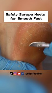 1.3K views · 16 reactions | Safely Scrape Heels for Smooth Feet | By Famous Podiatrist Miss Foot Fixer. #scrapeheels #SmoothFeet #toenailcare #thickcallus | Miss Foot Fixer | Facebook