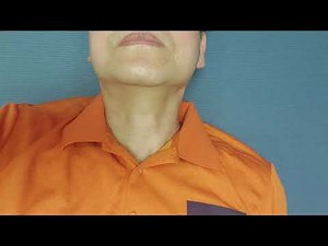 The Mendelsohn Maneuver for treating patients with pharyngeal dysphagia (disfagia faríngea. 咽部吞咽困难)