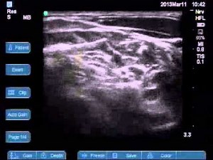 Cervical Plexus block, Interscalene block & suprascapular Nerve block for shoulder surgery