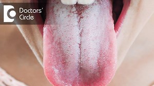 Oral thrush is a yeast infection which develops on inside the cheeks, on the tongue, on the gum pads and on the tonsils. So, it is generally called as a oropharyngeal candidiasis or candidiasis. So the main cause off the oral thrush is because of candida albicans fungus. So, oral thrush is not at all contagious, it is not at all hereditary, it does not run from family to family. So, it occurs when there is a yeast development over the surface of the tongue like in case of depressed immunity, in 