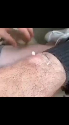 Satisfying Pimple Popping - Oddly Satisfying Compilation