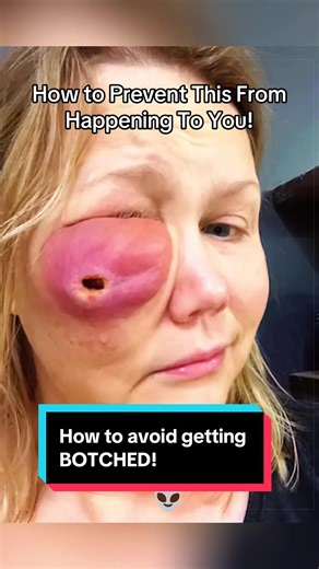 How to Avoid Botched Plastic Surgery Procedures