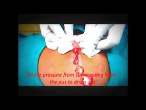 Huge Infected Sebaceous Cyst Back Drainage 2014 YouTube