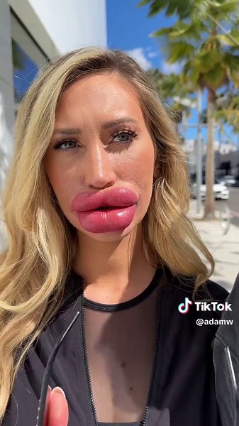 Lip Enhancement Journey with Tayray Texas