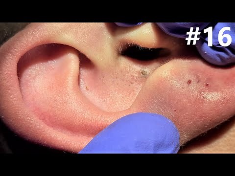 BLACKHEADS EXTRACTIONS on Happy #16