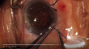 30-Gauge Needle Levitation of a Dropped IOL - Eyetube