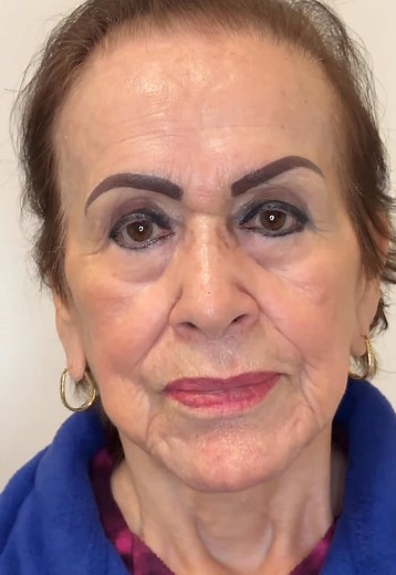 Effective Solutions for Marionette Lines Treatment