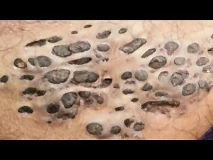 Nevus, Blackheads, Comedones and Dilated Pores of Winer