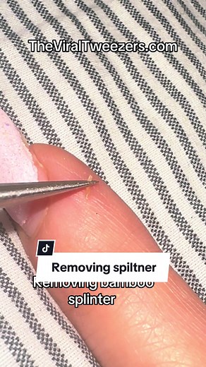 Removing a splinter 🪵 #skincare #skincareroutine #splinter