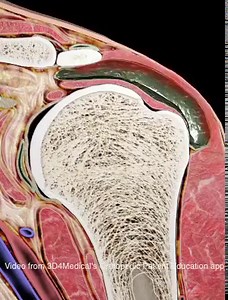 516 reactions · 1.2K shares | Subacromial bursitis is a condition...
