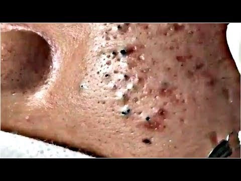 remove blackheads on face so so amazing #2019