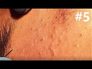 BIG BLACKHEADS EXTRACTIONS on Happy :) #5