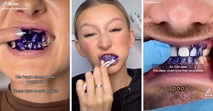 Elle blanchit ses dents avec du shampoing violet, le résultat est choquant
