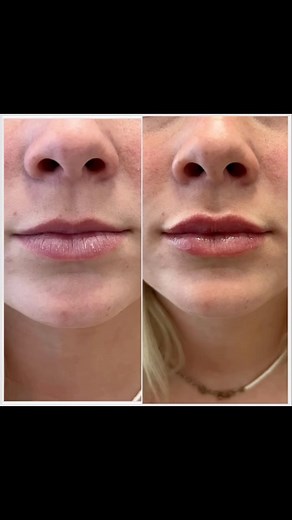 1/2 syringe was used to create volume and hydration for this gorgeous gal! For the month of July we are offering $150 off of a full syringe! | Modern Medspa Utah