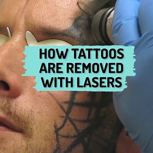 574K views · 486 reactions | This is how laser tattoo removal works  GO! Tattoo Removal | Ultimate | Facebook