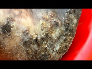 Joshua Olumela (71) jigger digging - - subscribe now @riseupsociety.net to watch FULL VIDEO