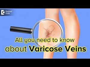 Varicose Veins: Symptoms, Risk Factors, Diagnosis, Treatment - Dr. Harish NS | Doctors' Circle