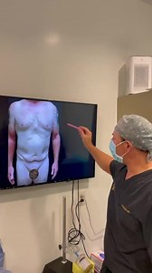 #maletummytucksurgery #maleplasticsurgery #tummytuck #maleplasticsurgery #tummytuckexplained #bestplasticsurgeon #drsessaresults #sessa #sarasotatummytuck #floridaplasticsurgery | Sarasota Surgical Arts - Dr. Alberico Sessa