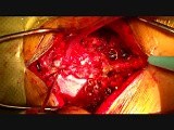 Cervical Laminectomy • Video • MEDtube.net