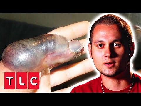 “It Looks Like A Space Alien Slug!” Horrifying Story Of Deadly Stiletto Snake Bite | I Was Bitten