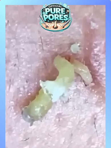 Soothing Facial Treatments ASMR Compilation – Blackhead & Pimple Removal